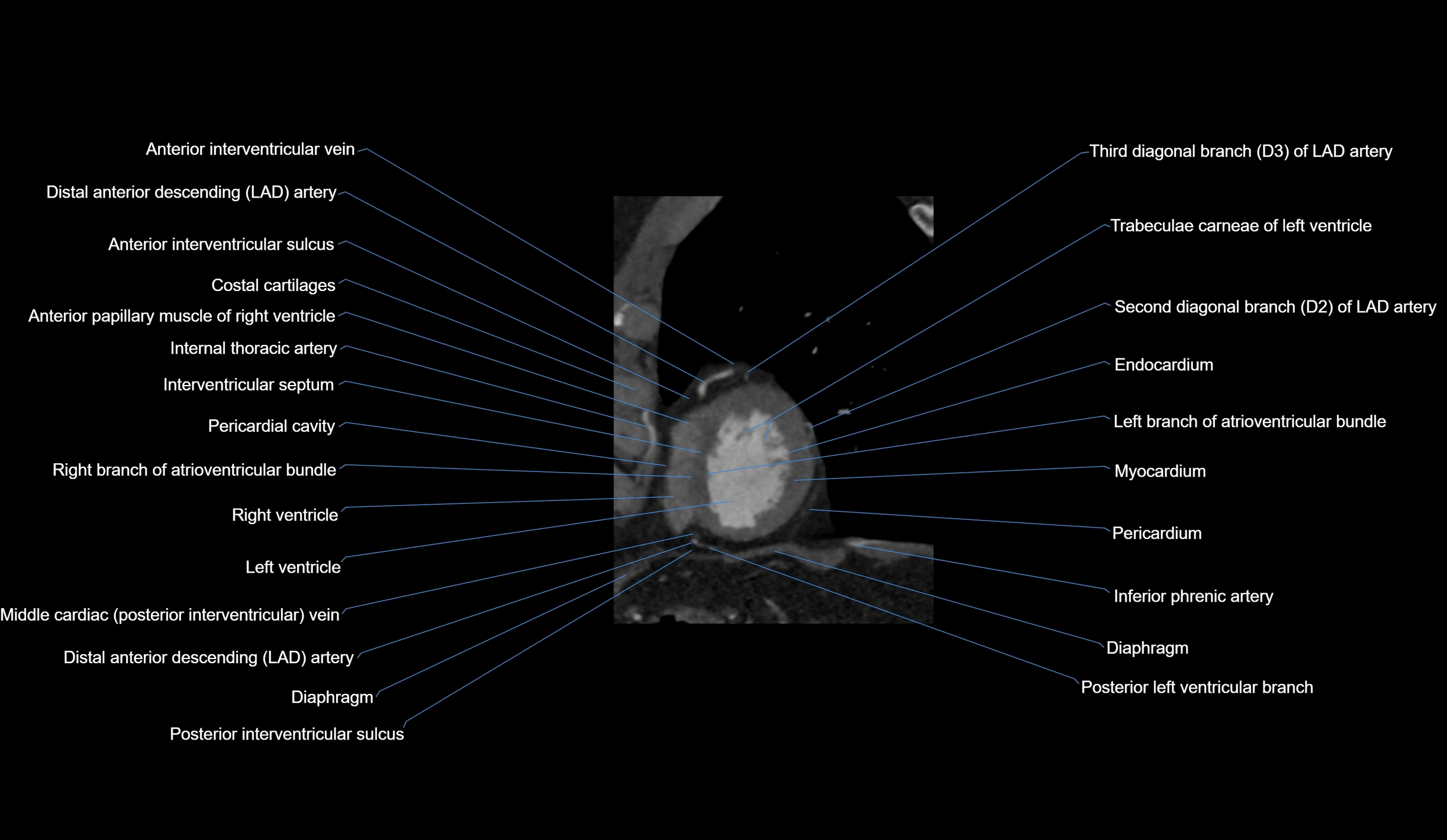 CT heart (coronary angiogram) short axis view  cross sectional anatomy labelled radiology image-00044.webp